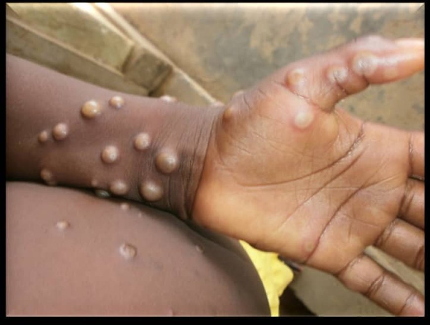 Monkeypox ou variole du singe : voici un portrait robot de la maladie