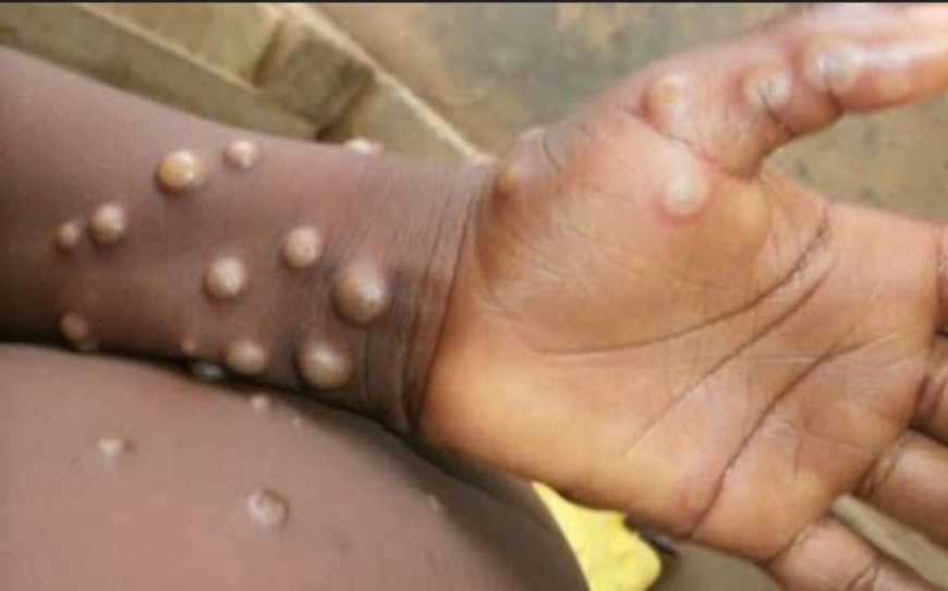 RDC : 663 décès dus au Monkeypox enregistrés en 2023 