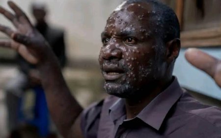 Afrique : le Monkeypox en passe de devenir une urgence de santé publique